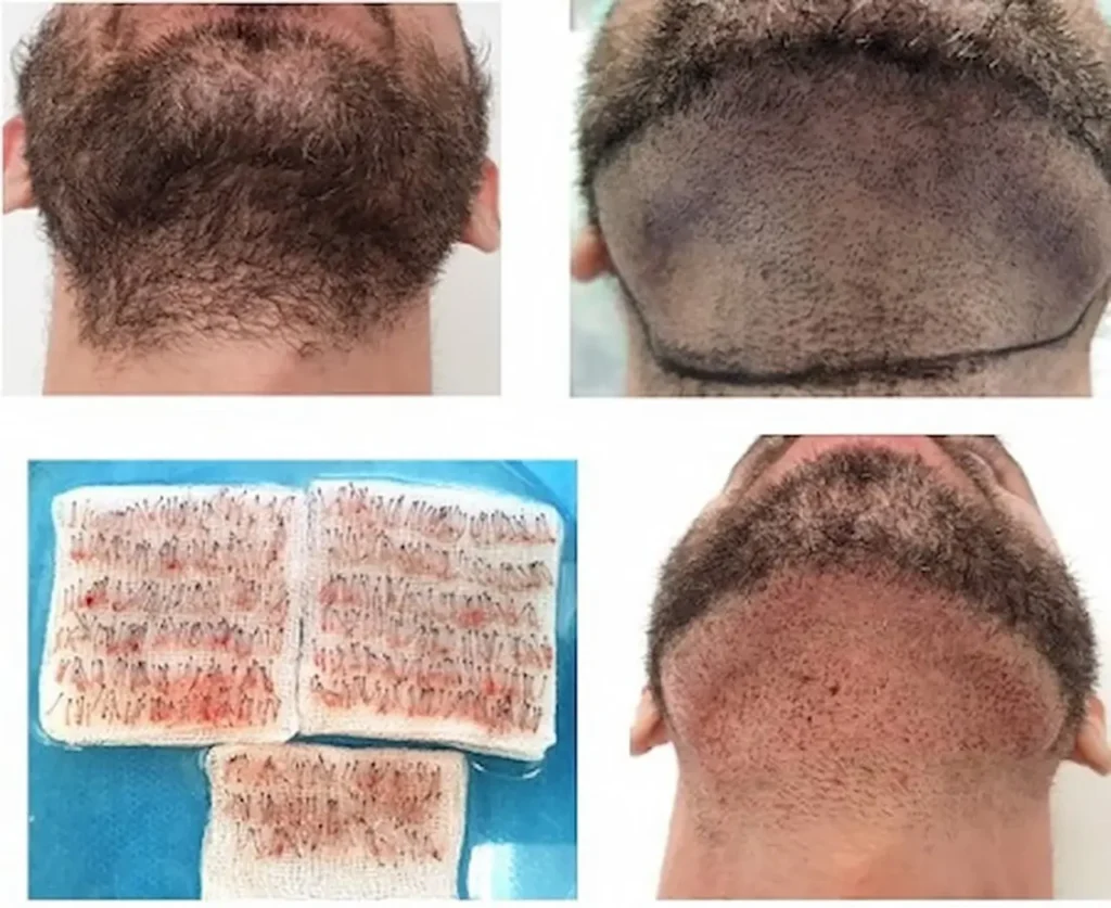جدیدترین روش کاشت مو