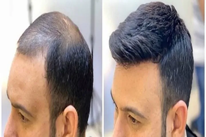 کاشت مو به روش HRT